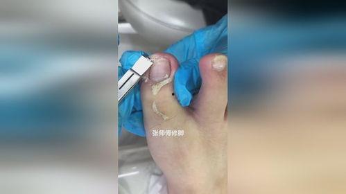 甲沟炎修脚视频,专业指导，轻松告别脚部困扰