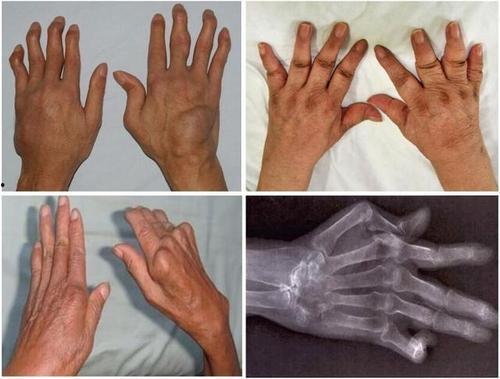 类风湿关节炎按摩视频,专业按摩视频教程解析