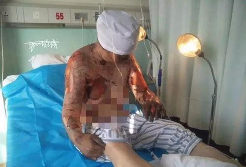 烧伤视频,紧急救援与救治纪实