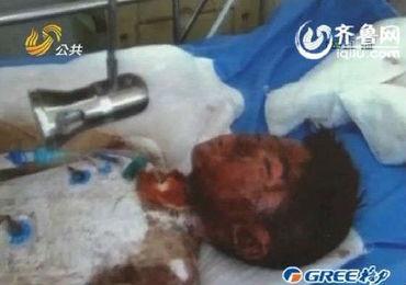 烧伤视频,紧急救援与救治纪实